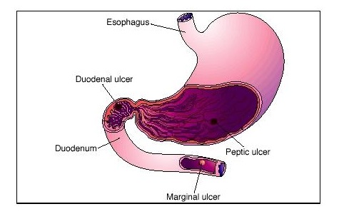 Peptic Ulcer Treatment in Jammu