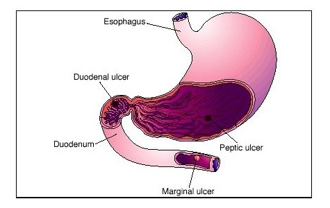 Peptic Ulcer Treatment in Surat