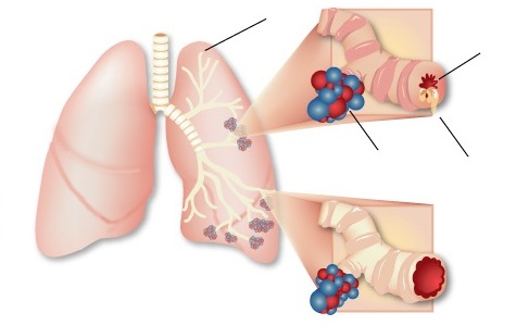 Asthma Treatment in Vijayawada