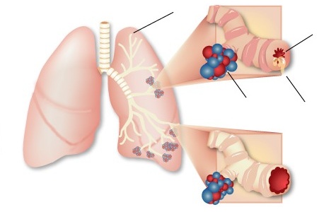 Asthma Treatment in Bhopal