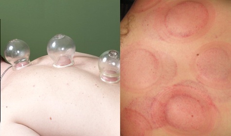 Cupping Therapy in Bangalore