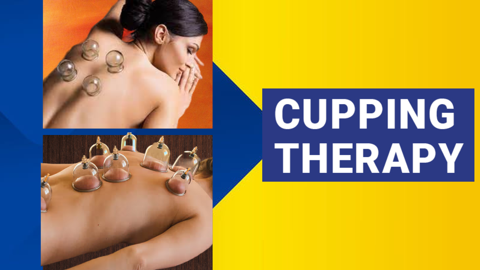 Cupping Therapy in Nagpur