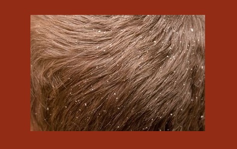 Dandruff and Hair Fall Treatment 