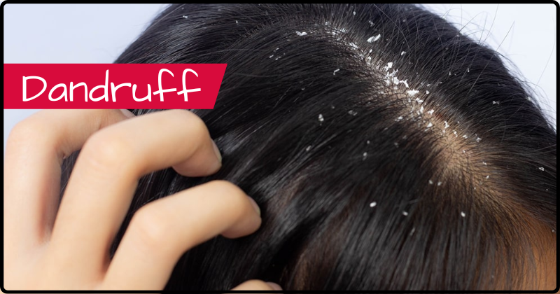 Dandruff and Hair Fall Treatment in Dubai