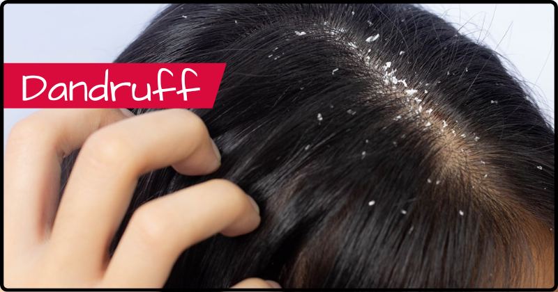 Dandruff and Hair Fall Treatment in New York