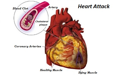 Heart Disease Treatment in Indore